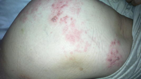 骨瘦如柴就是美?女性牛皮癣患者需注意 骨瘦如柴就是美?女性牛皮癣患者需注意