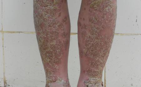 与广州治疗牛皮癣医生探寻脓疱型牛皮癣是什么